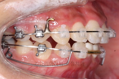 연산동치아교정