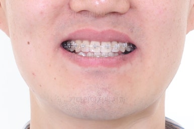 부산비수술교정