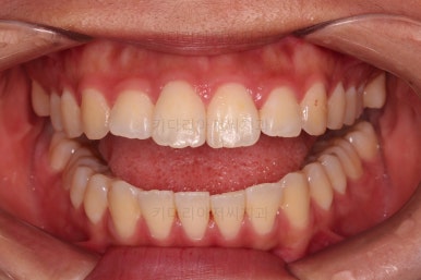 부산연산역치아교정