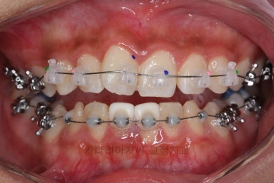 연산동치아교정