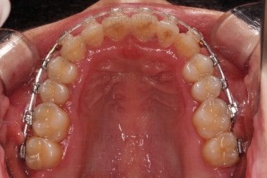 부산비발치교정