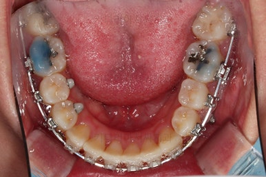 부산비대칭교정