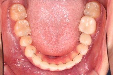 부산사랑니교정