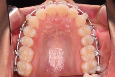 부산교정잘하는치과