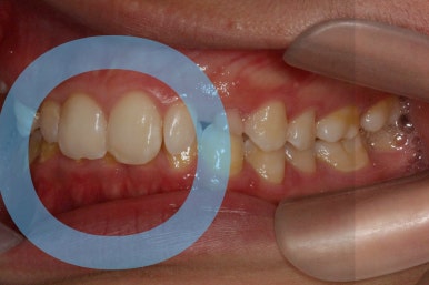 부산왜소치교정