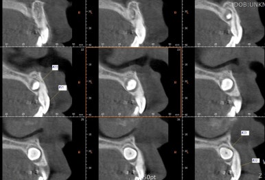 부산매복치아교정