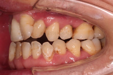 부산구순구개열교정