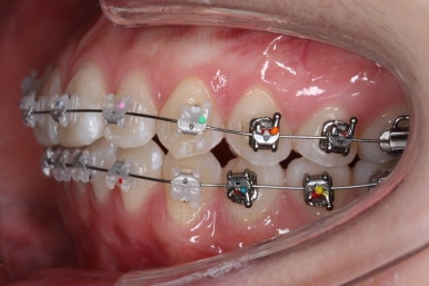 부산치아교정잘하는곳