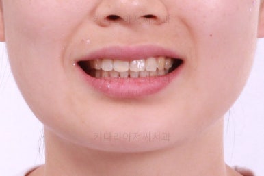 부산앞니부분교정