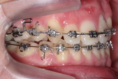 부산구순구개열