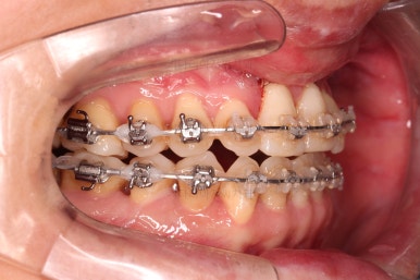 부산구순구개열교정