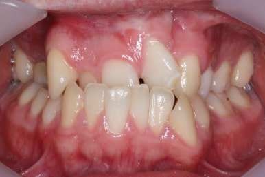부산구순구개열