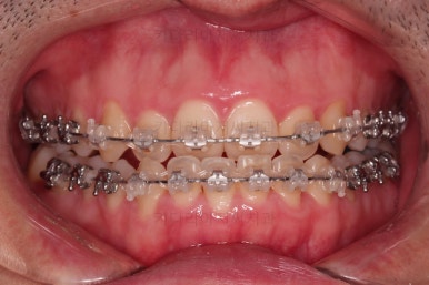 부산긴얼굴긴턱교정