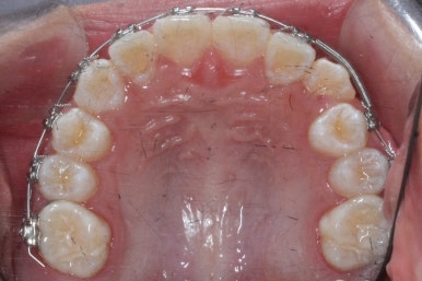 연산동덧니교정