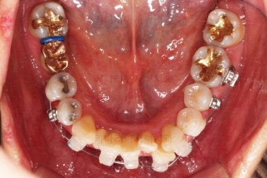 동래임플란트교정