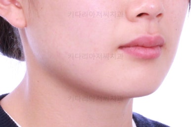 부산앞니부분교정