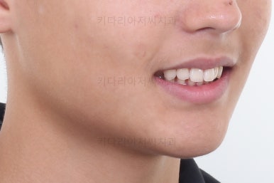 부산연산동치아교정