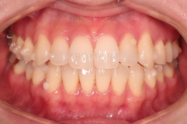 부산인비절라인