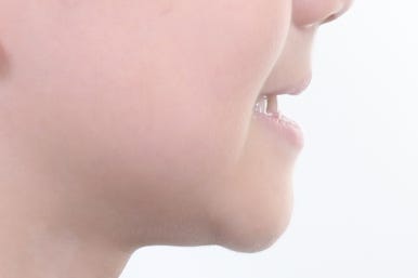 부산어린이치아교정