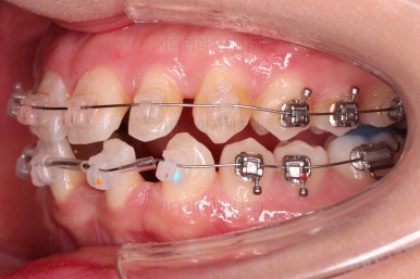 부산교정치과추천