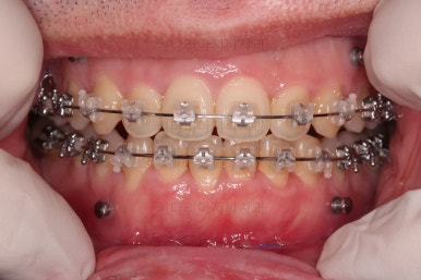 부산긴얼굴긴턱교정