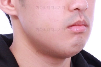부산긴얼굴긴턱교정
