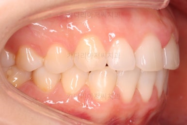 부산나비앞니교정