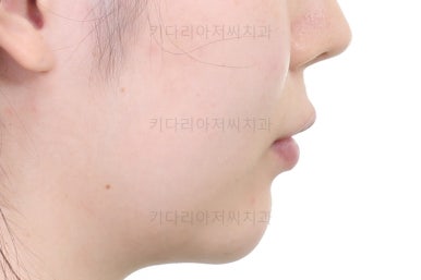 부산부분치아교정