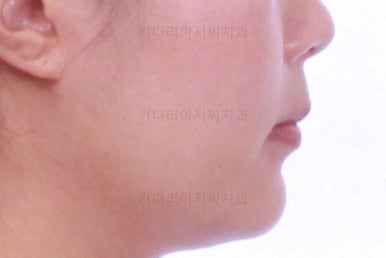 부산치아교정비용