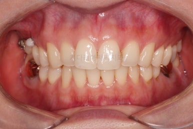 부산치아교정비용