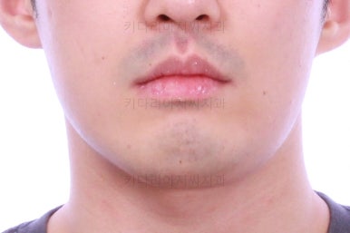 부산긴얼굴긴턱교정