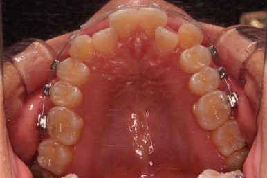 부산비발치교정