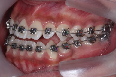 부산주걱턱교정