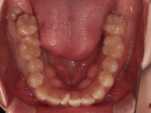 부산보철잘하는곳