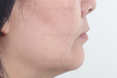 부산옥니교정