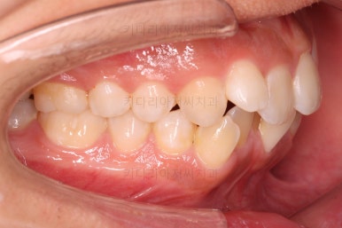 부산청소년치아교정