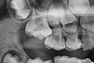 부산어린이치아교정