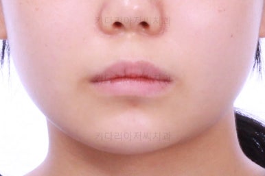 부산앞니벌어짐교정