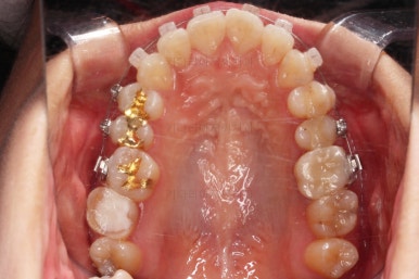 부산사랑니교정