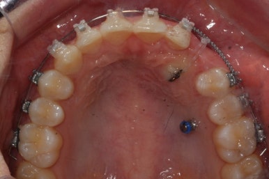 부산매복치아교정