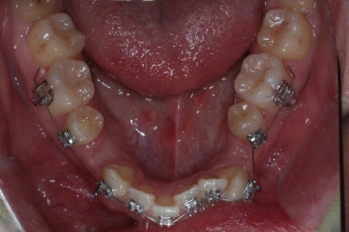 부산구순구개열
