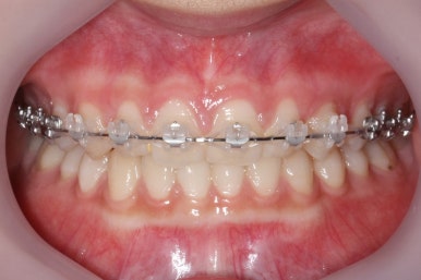 부산매복치아교정