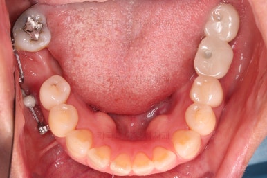 연산동부분교정