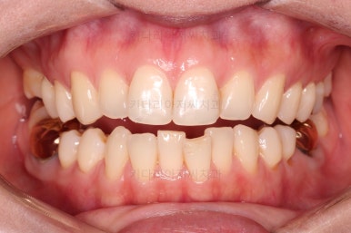 부산치아교정비용