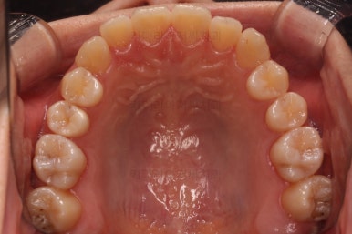 부산치아교정추천