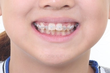 부산토끼치아교정