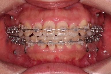 부산비발치교정
