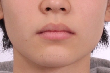 부산연산동치아교정