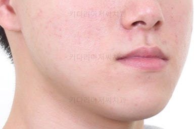 부산주걱턱교정