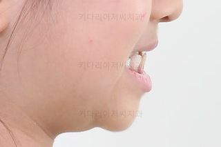 부산어린이치아교정